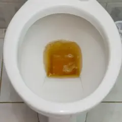Przyczyny bardzo ciemnego moczu i co oznacza jego kolor?