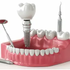 Ile kosztuje implant zęba 6: Jaka jest cena implantu zęba 6?