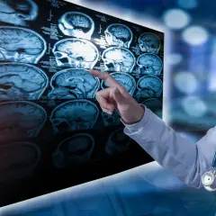 Co to SM: SM - tajemnicza choroba demielinizacyjna