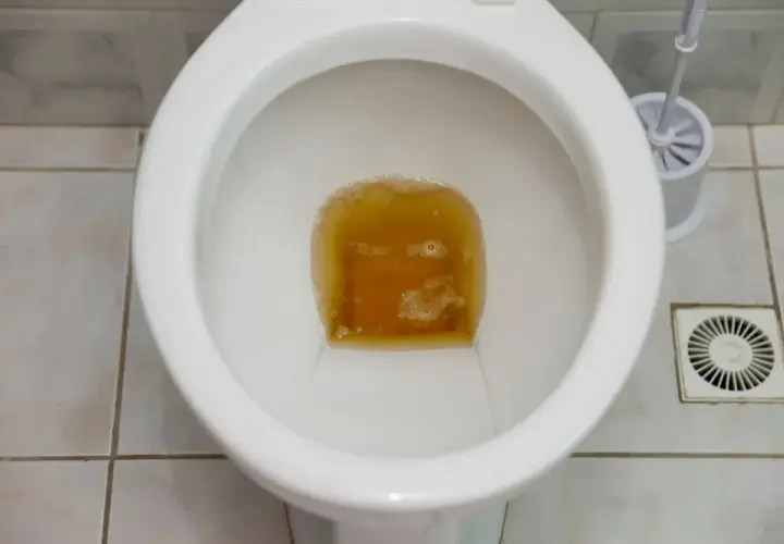 Przyczyny bardzo ciemnego moczu i co oznacza jego kolor?