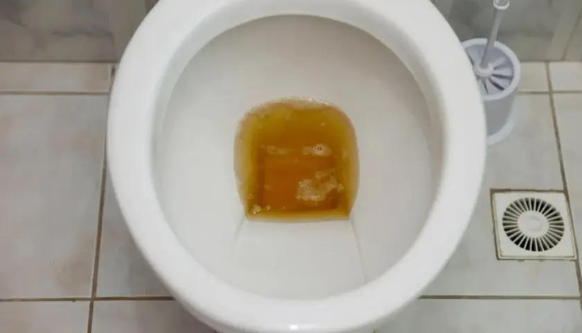 Przyczyny bardzo ciemnego moczu i co oznacza jego kolor?