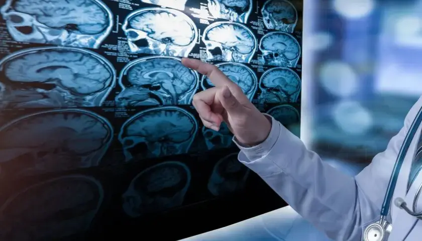 Co to SM: SM - tajemnicza choroba demielinizacyjna